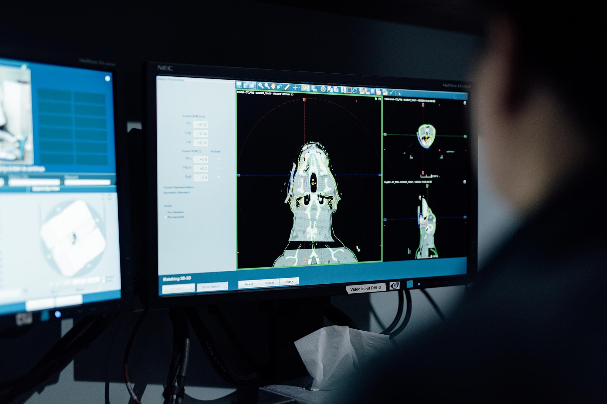 shot of computer screens during radiation treatment